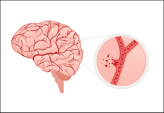 A la izquierda, una imagen del interior del cerebro y sus arterias. A la derecha, la ampliación de una arteria sangrando.